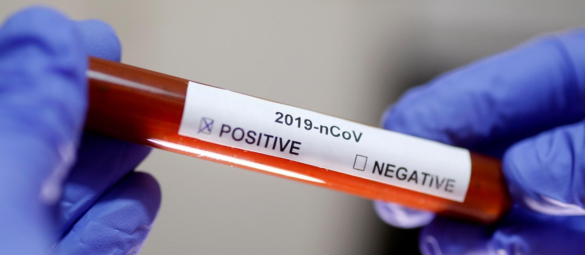 Mais dois casos de coronavírus são confirmados em Cianorte