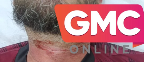 Motociclista sofre corte no pescoço provocado por linha chilena