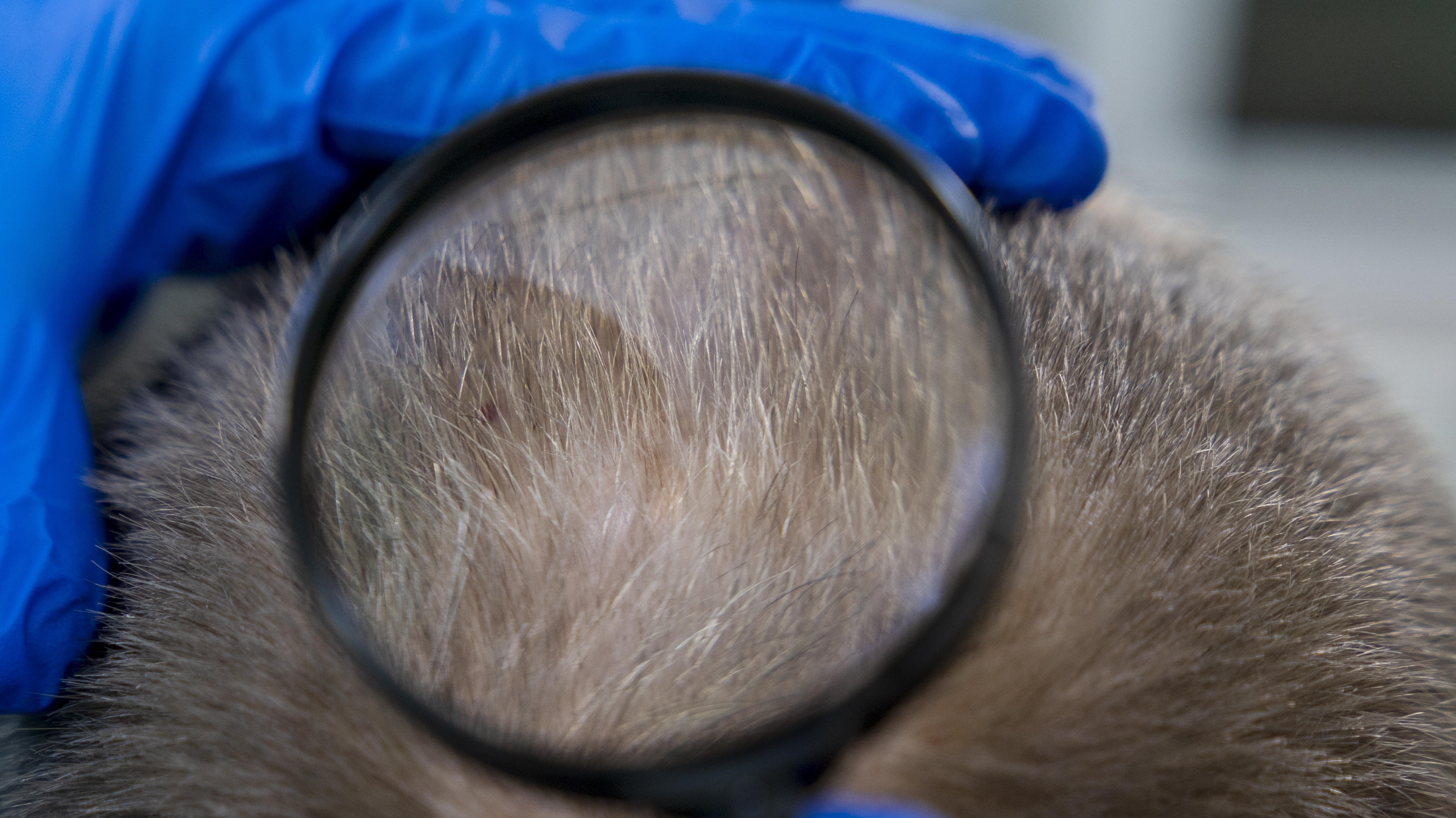 Procura por transplante capilar tem crescido entre os homens; entenda