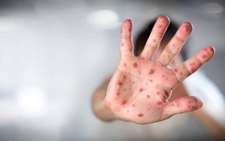 Paraná tem sete casos de sarampo confirmados e 24 sob investigação