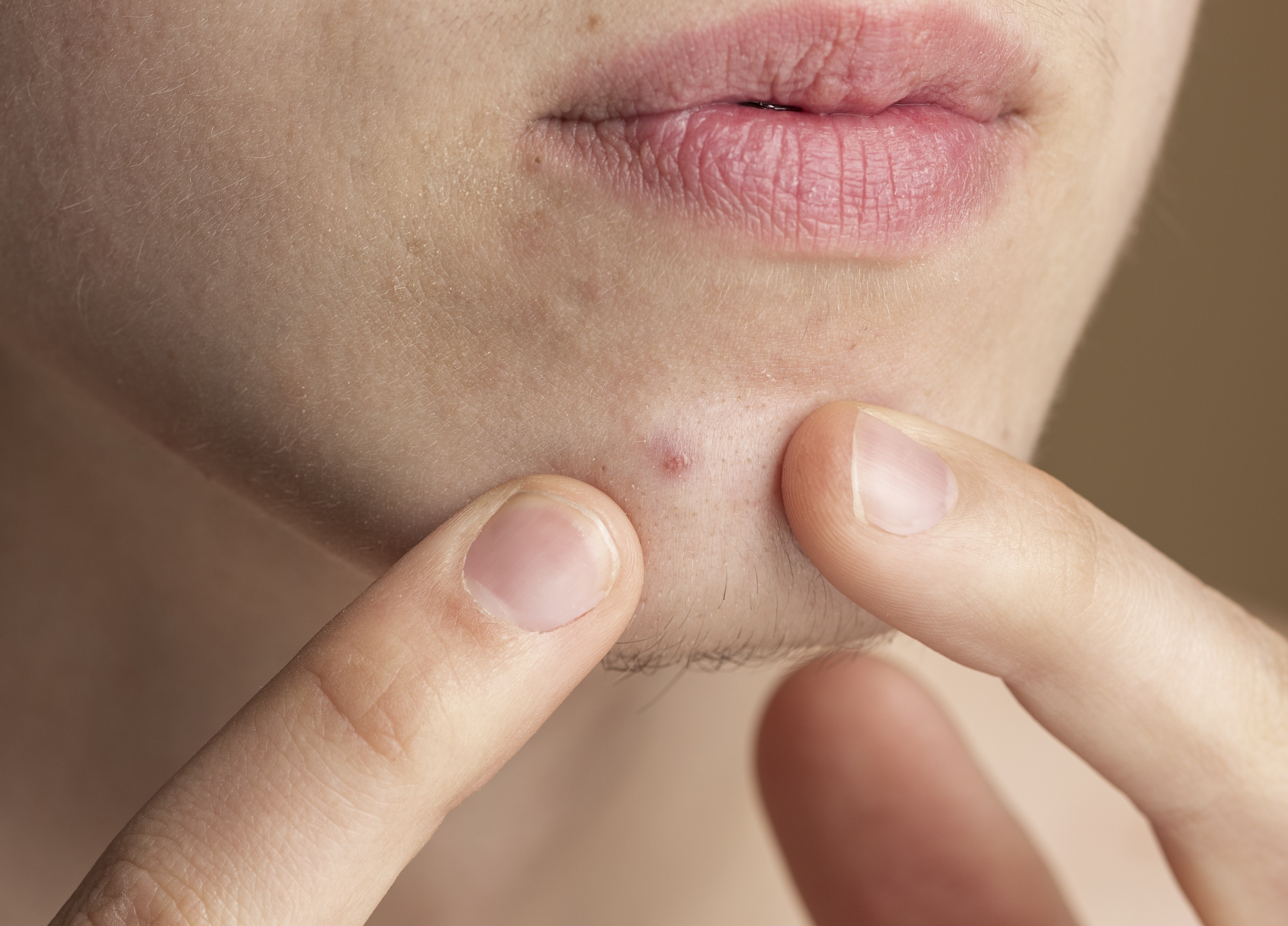 Consumo excessivo de chocolate pode dar acne?