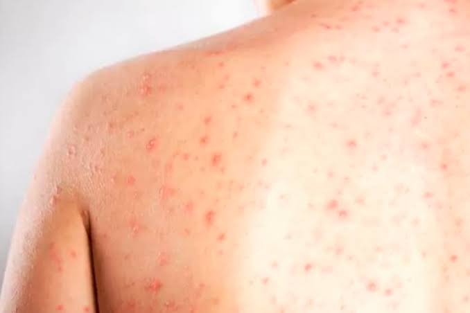 Maringá tem 70 mil jovens na faixa etária da vacinação contra sarampo