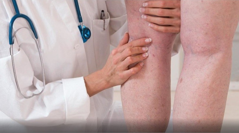 Campanha “Ame suas pernas” alerta para os riscos de trombose venosa