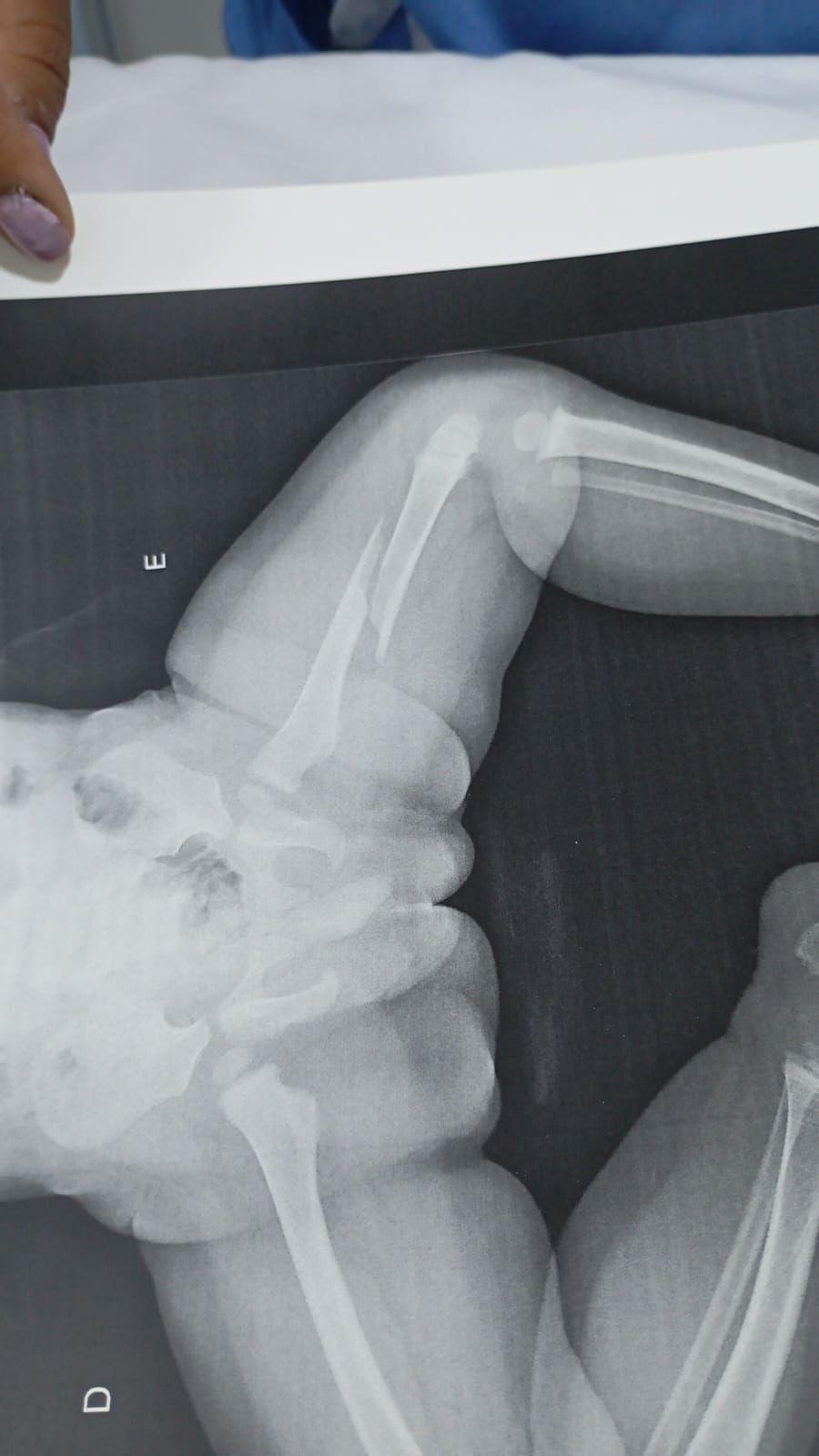 Avó de criança internada com fratura no fêmur relata desespero ao ver neto