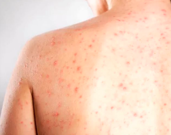 O vírus da doença está circulando no Paraná