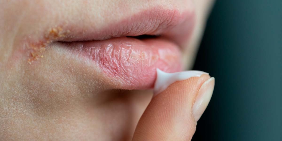 Síndrome de Sjörgren pode atingir principalmente mulheres na menopausa