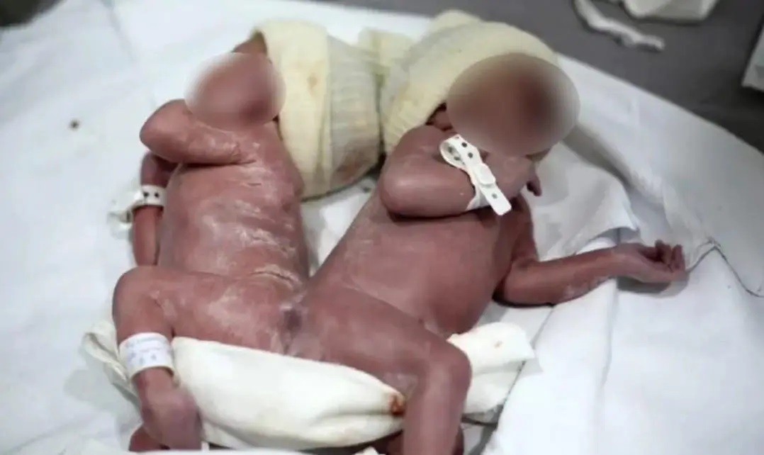 Caso raro: gêmeos siameses nascem unidos por osso da coluna, em Campo Largo