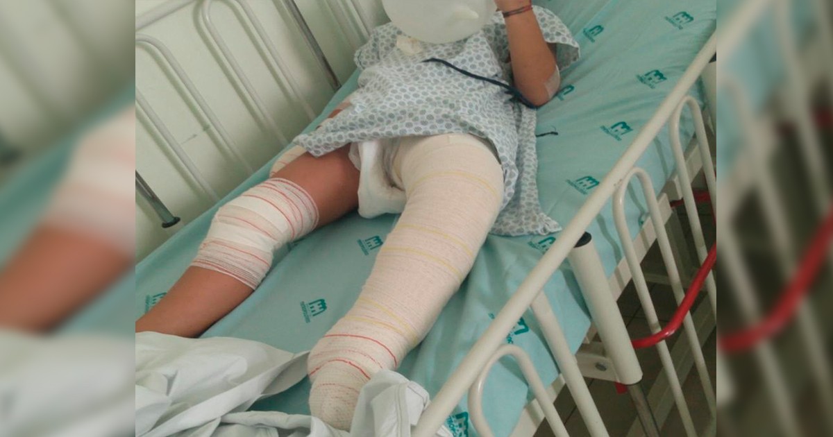 Menino que teve corpo queimado está há 20 dias internado