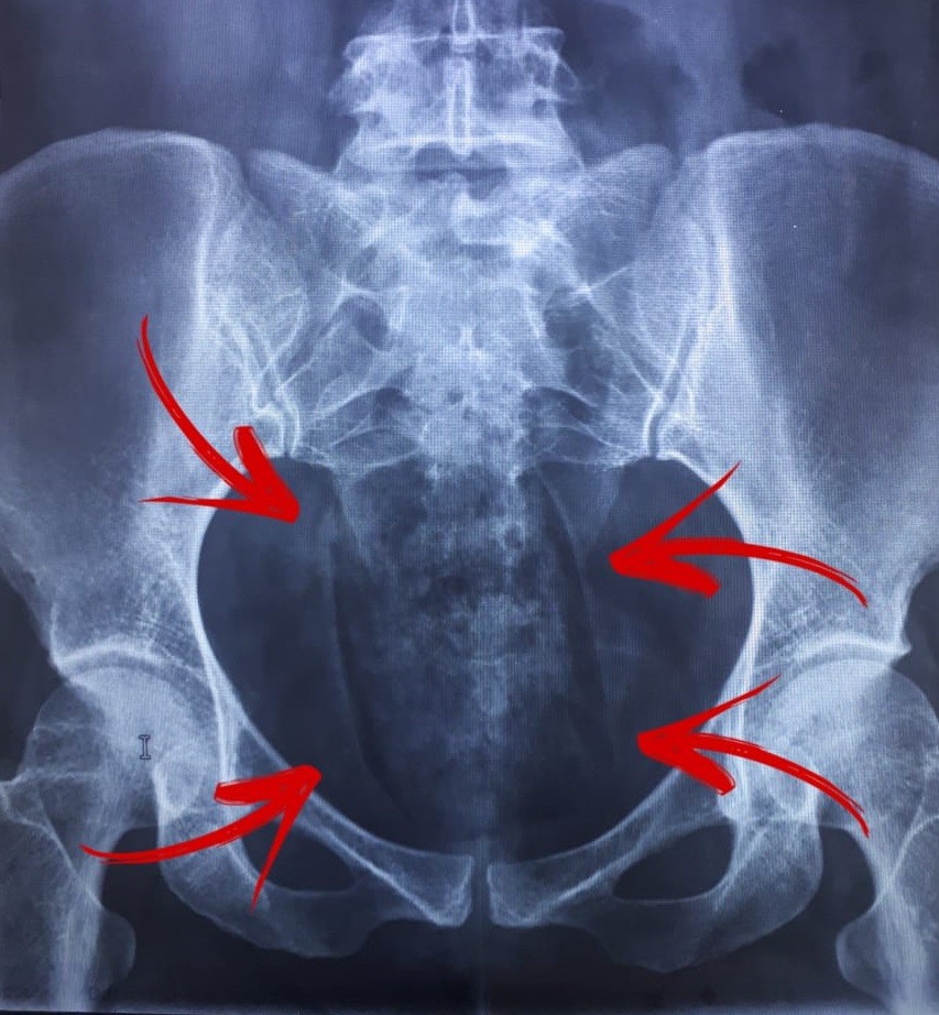 Duas mulheres são presas ao tentar entrar com drogas na vagina em presídio