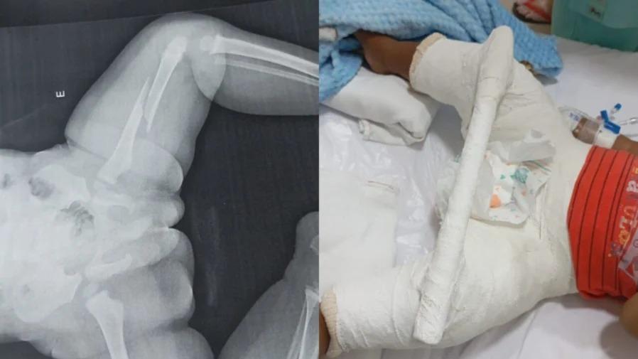 Bebê de 1 ano e 5 meses é internado em Maringá com fratura no fêmur