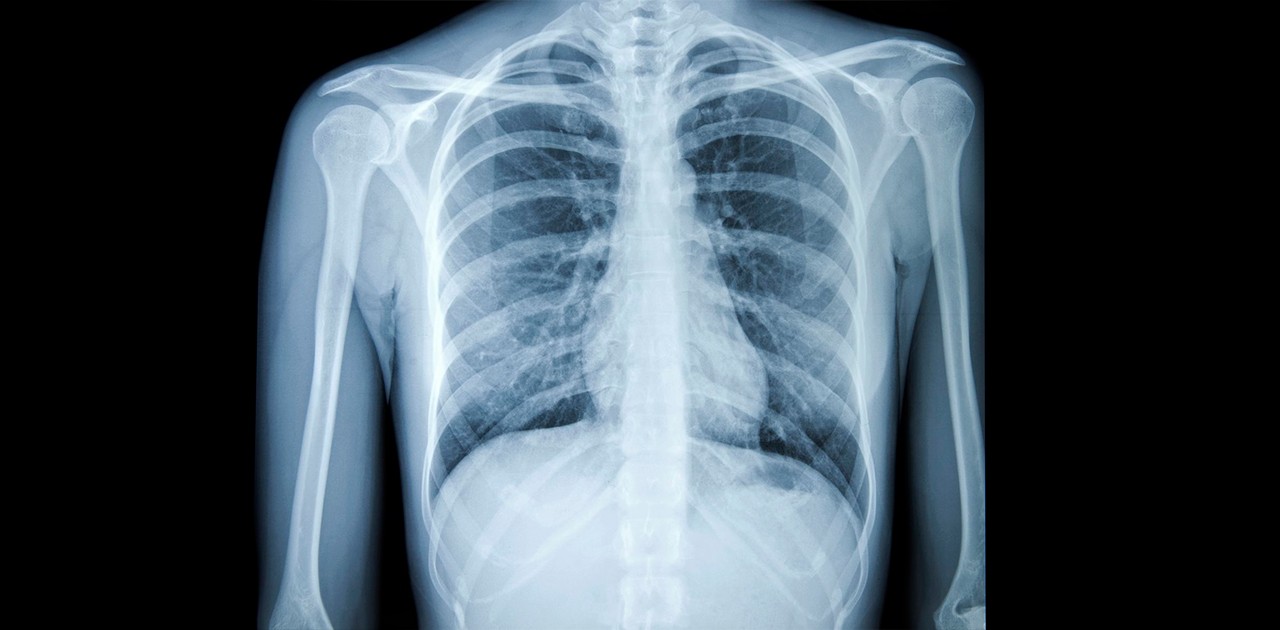 Cientistas da computação do Paraná descobriram uma maneira de confirmar a Covid-19