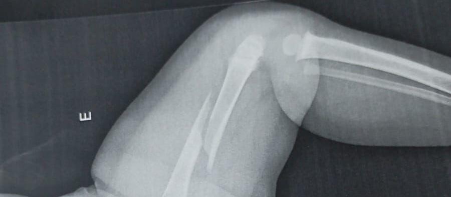 Avó de criança internada com fratura no fêmur relata desespero ao ver neto