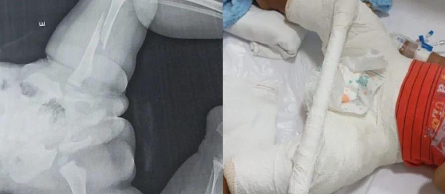 Bebê de 1 ano e 5 meses é internado em Maringá com fratura no fêmur