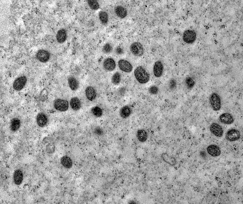 Saúde confirma primeiro caso de Mpox no Paraná em 2026